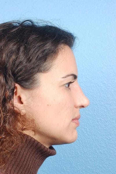 Hidden Patients Before & After Gallery - Patient 412997 - Image 1