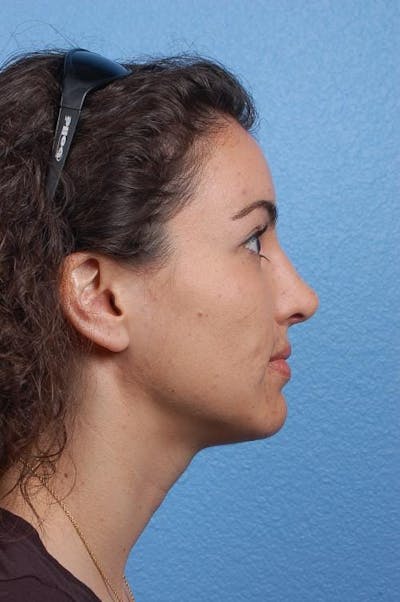Hidden Patients Before & After Gallery - Patient 412997 - Image 2