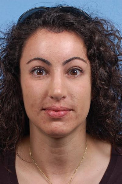 Hidden Patients Before & After Gallery - Patient 189141 - Image 2
