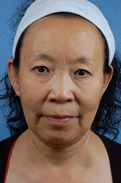 Hidden Patients Before & After Gallery - Patient 314303 - Image 1