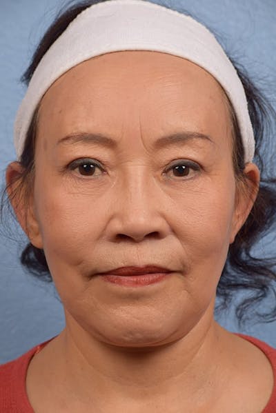 Hidden Patients Before & After Gallery - Patient 314303 - Image 2