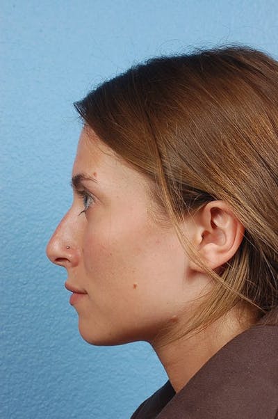 Hidden Patients Before & After Gallery - Patient 130468 - Image 1