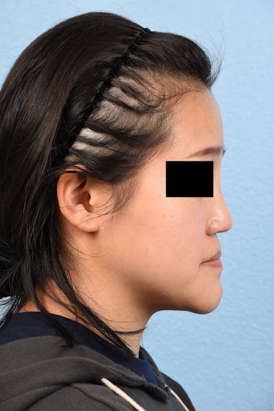 Hidden Patients Before & After Gallery - Patient 893076 - Image 1