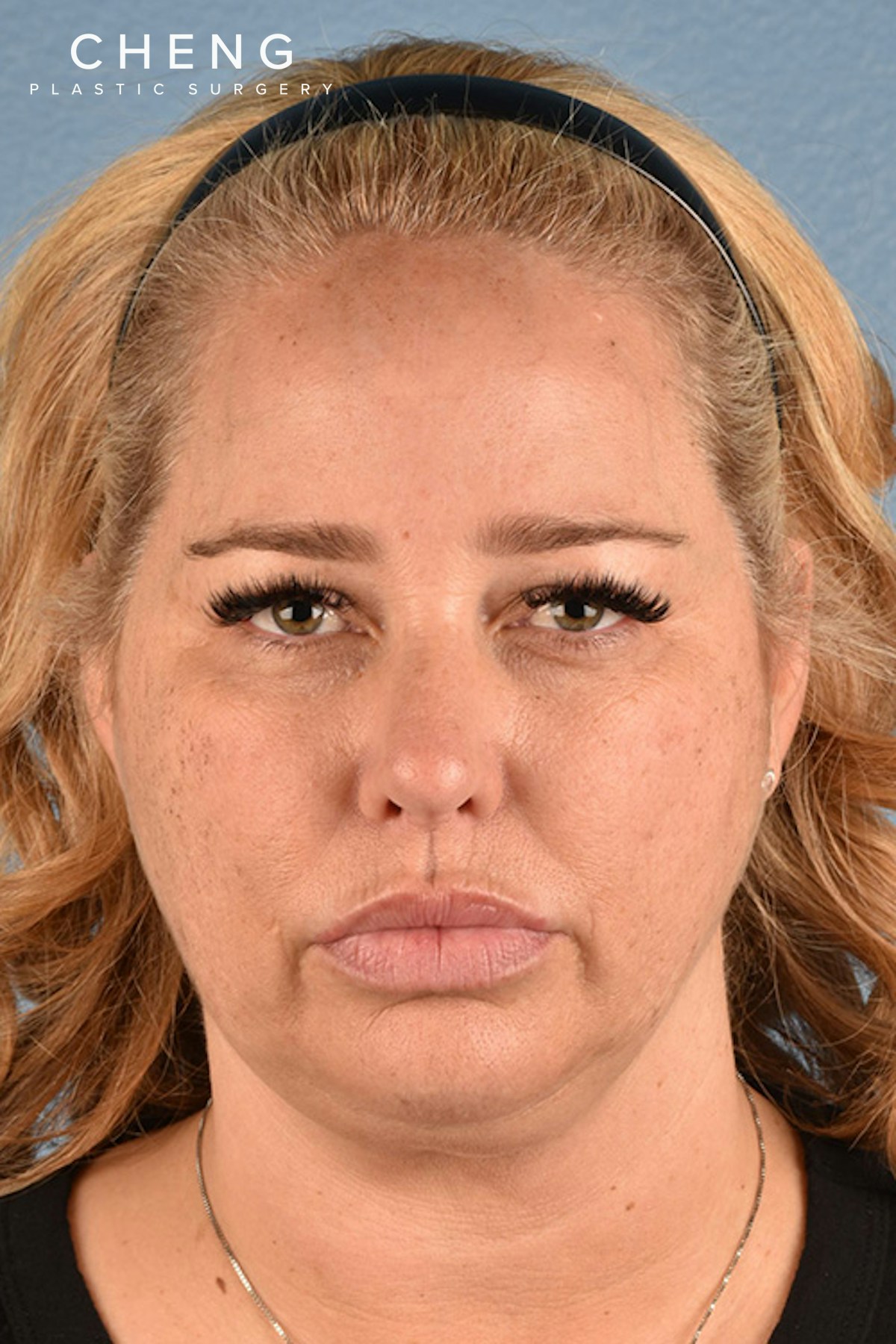Hidden Patients Before & After Gallery - Patient 217954 - Image 1