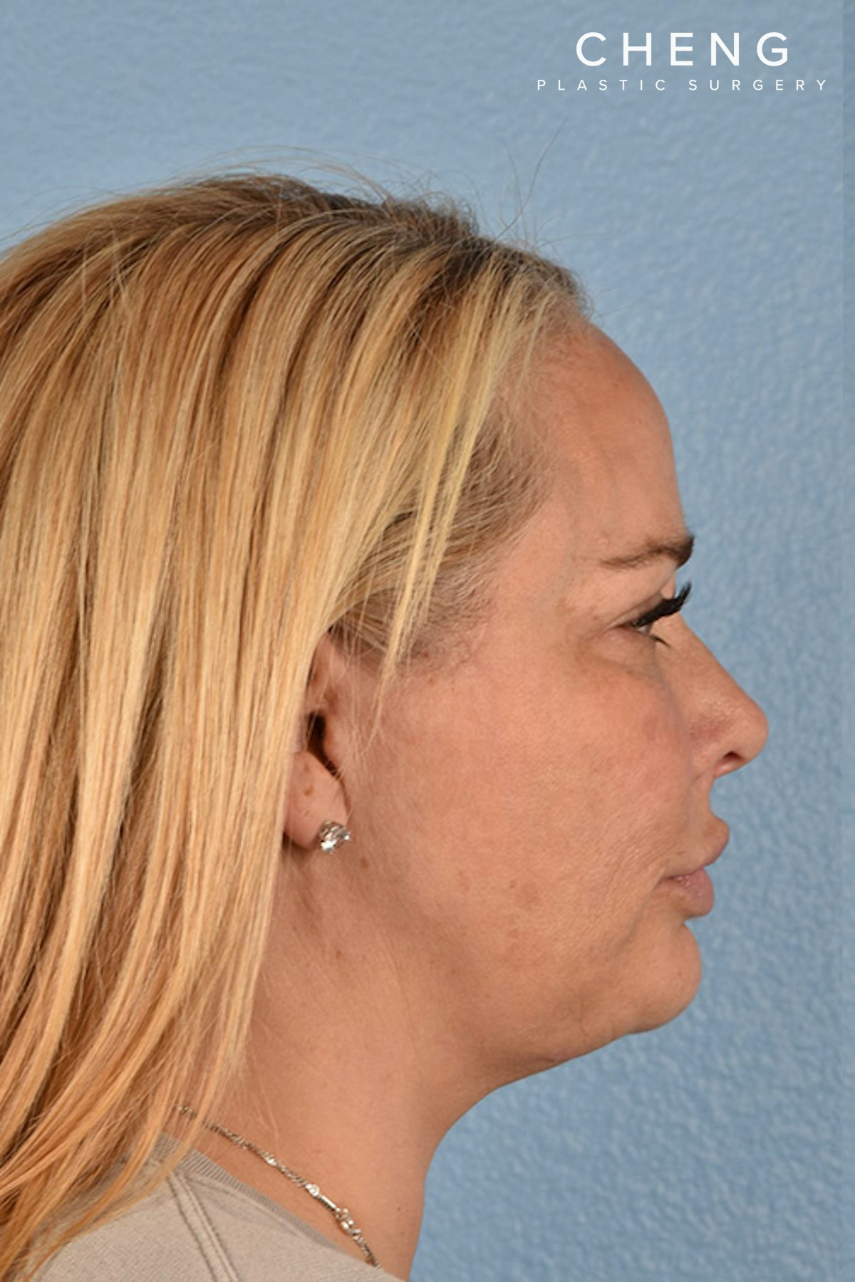 Hidden Patients Before & After Gallery - Patient 217954 - Image 6