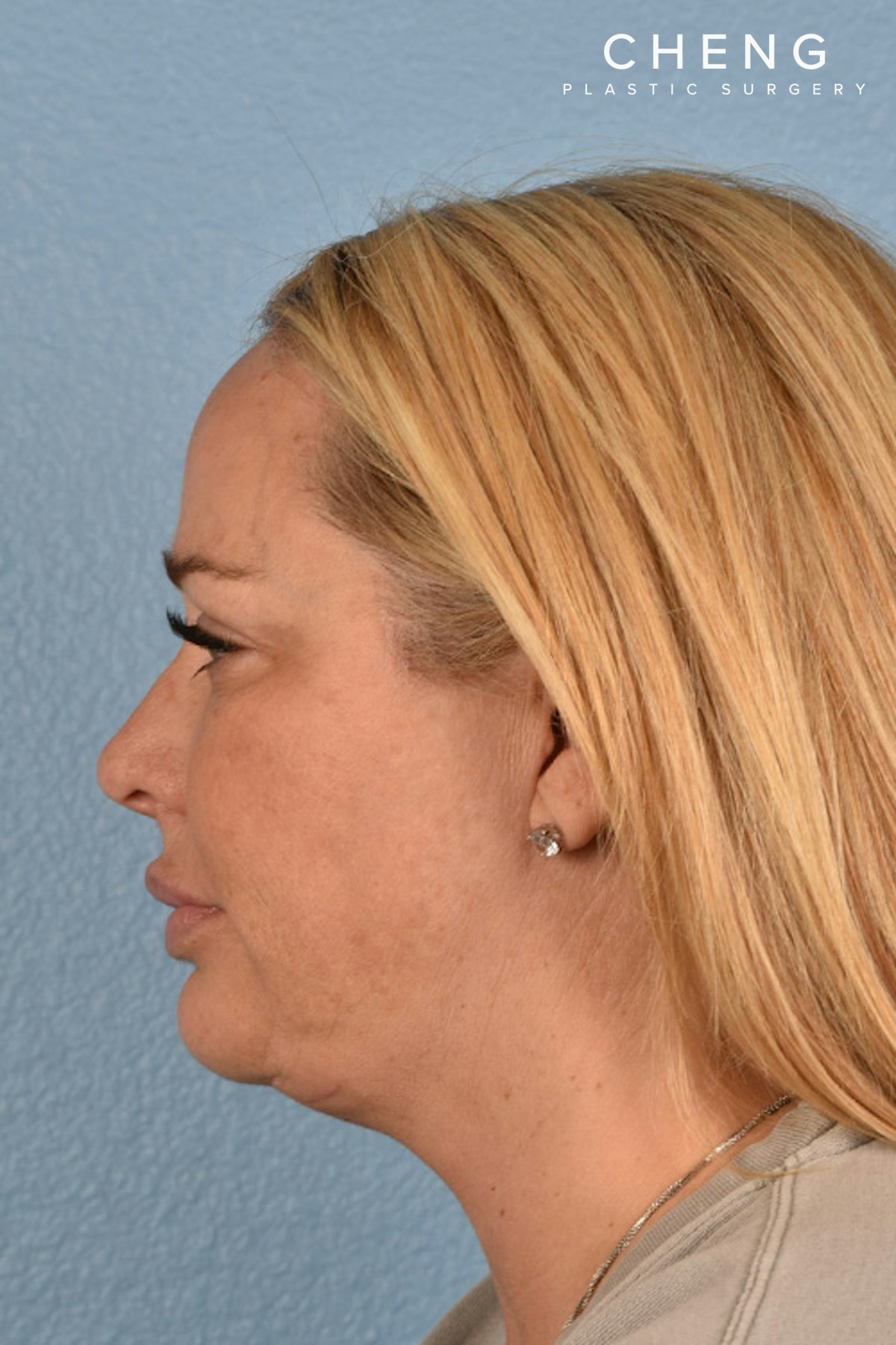 Hidden Patients Before & After Gallery - Patient 217954 - Image 8