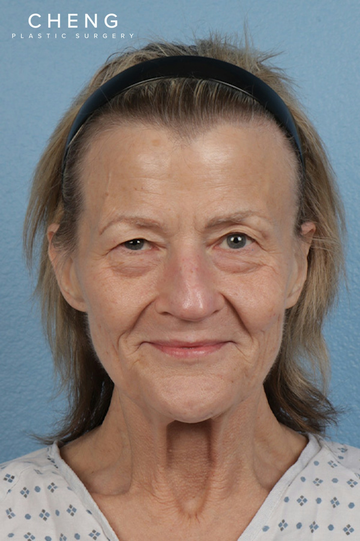 Hidden Patients Before & After Gallery - Patient 152793 - Image 1