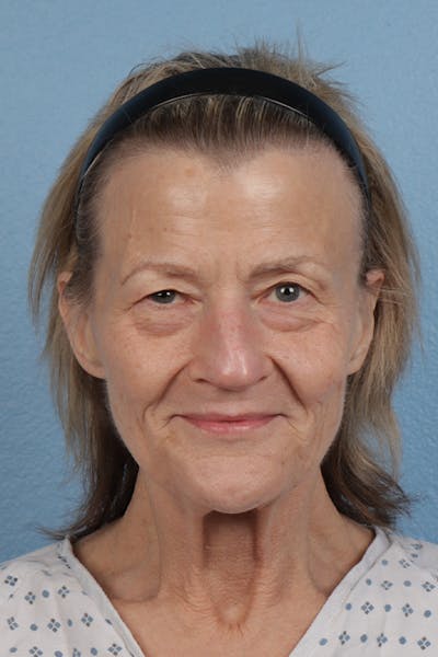 Hidden Patients Before & After Gallery - Patient 200732 - Image 1