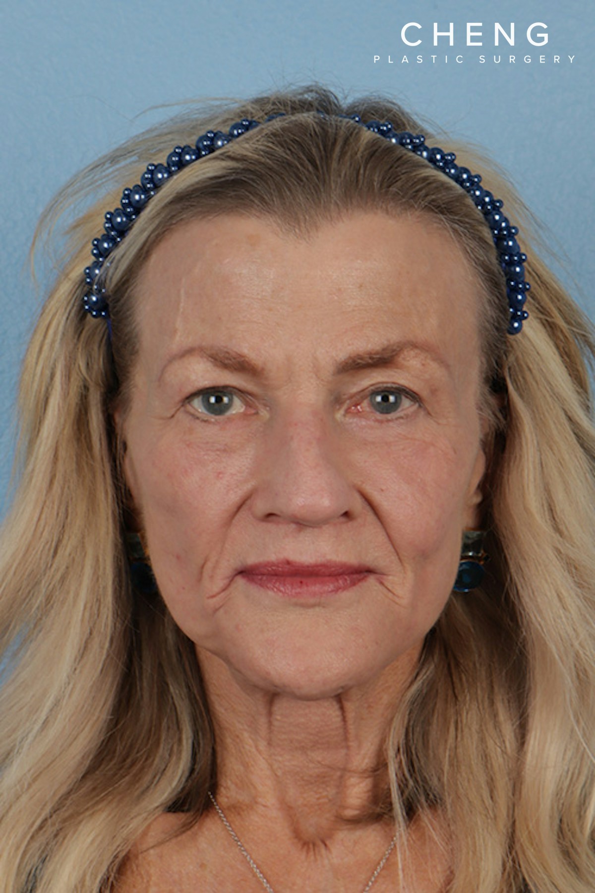 Hidden Patients Before & After Gallery - Patient 152793 - Image 2