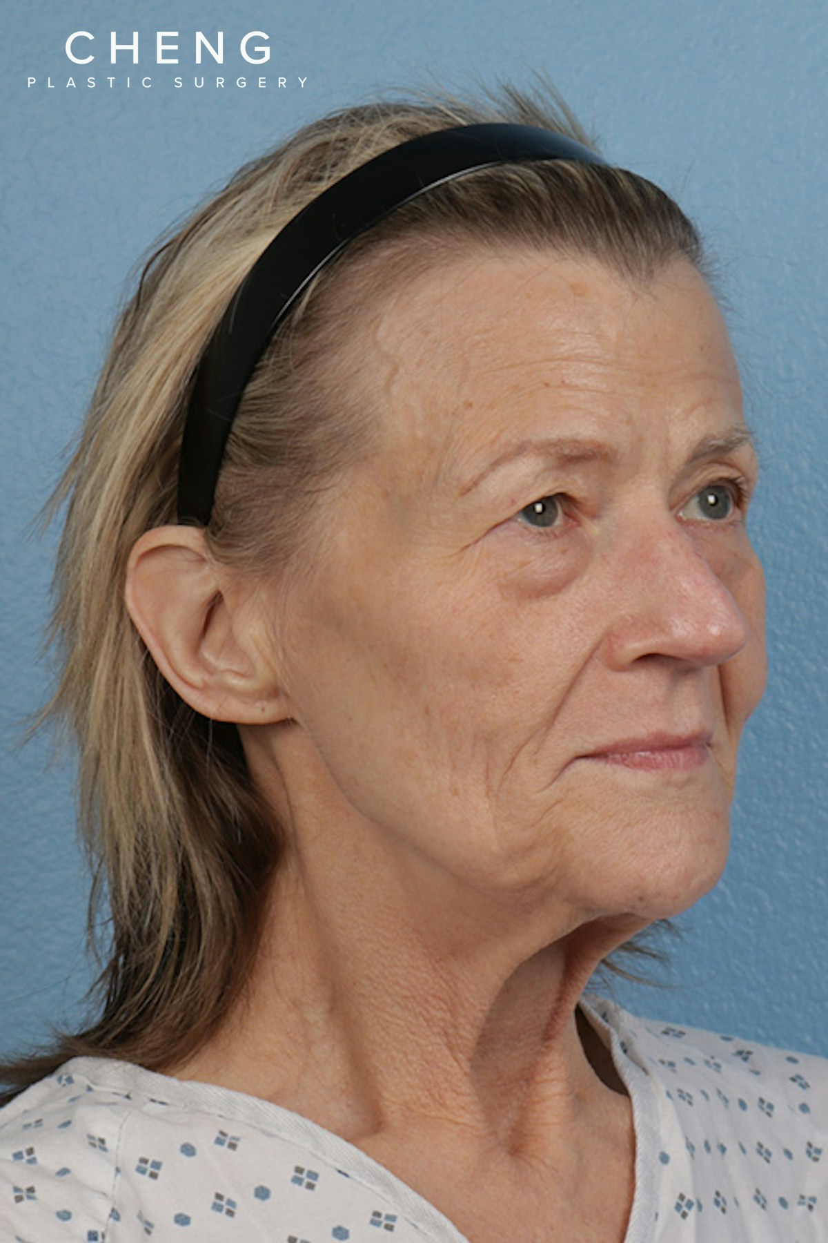Hidden Patients Before & After Gallery - Patient 152793 - Image 3