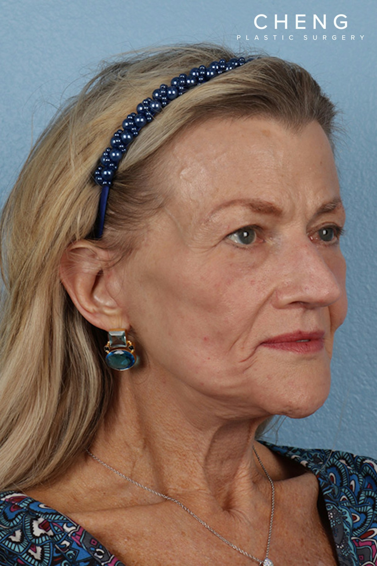 Hidden Patients Before & After Gallery - Patient 152793 - Image 4