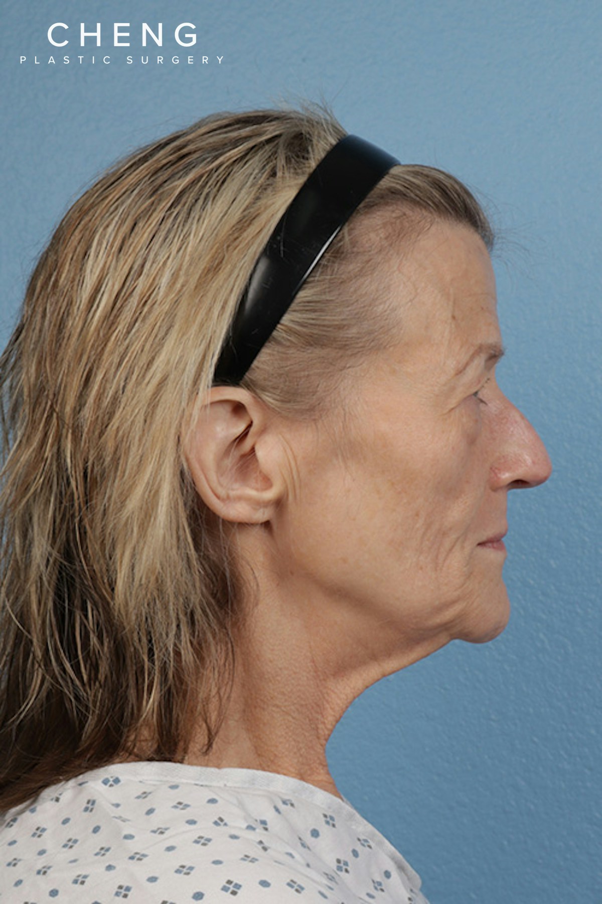 Hidden Patients Before & After Gallery - Patient 152793 - Image 5