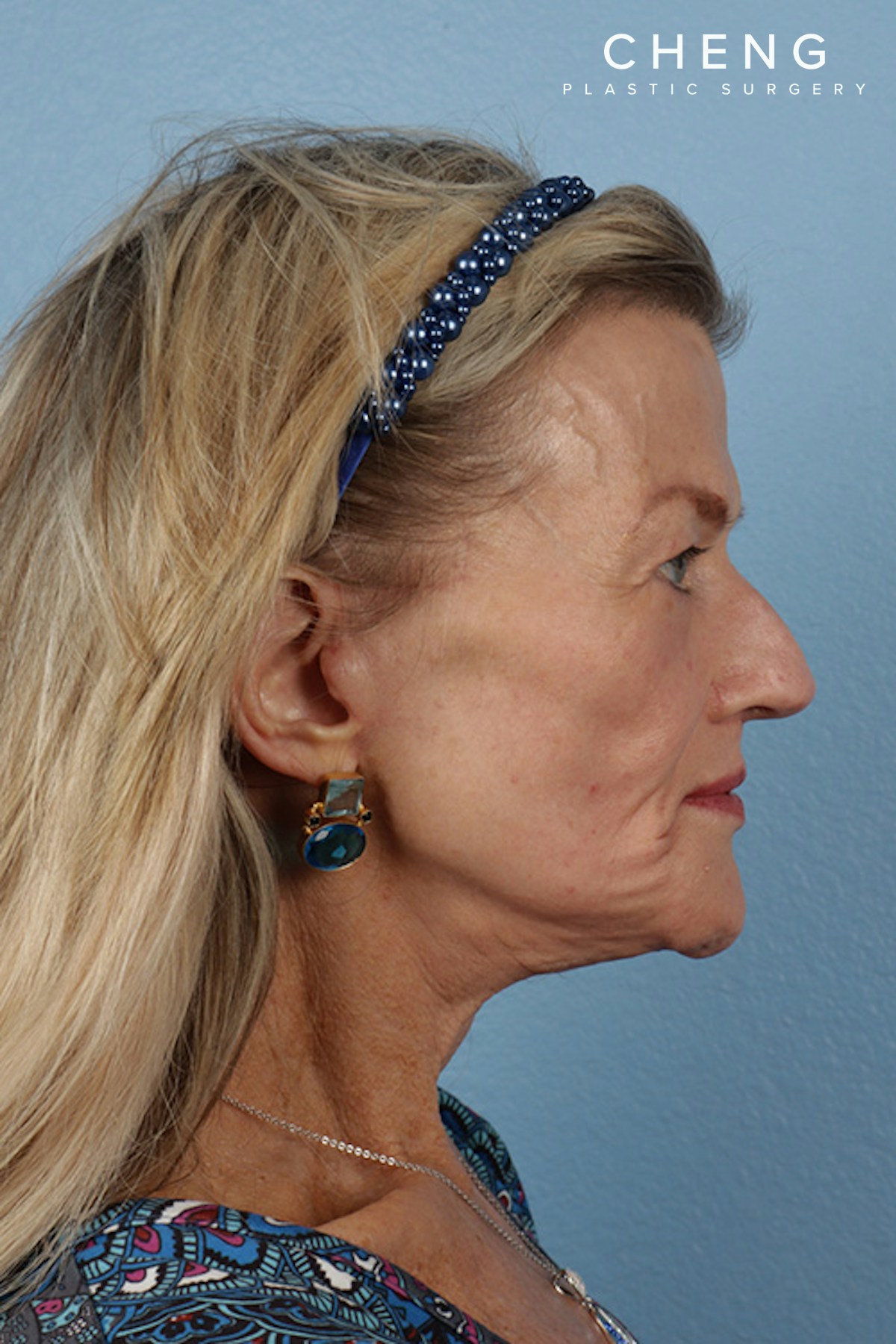 Hidden Patients Before & After Gallery - Patient 152793 - Image 6