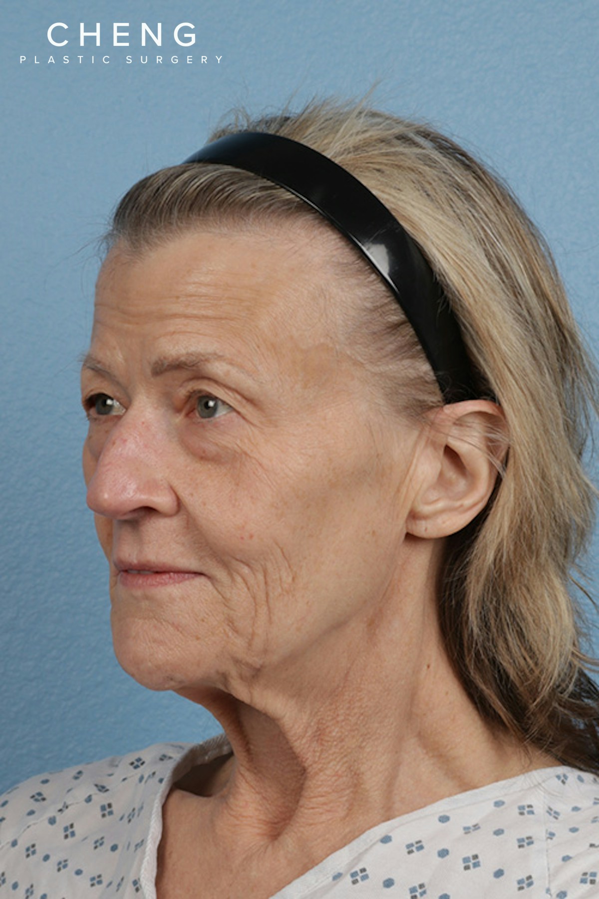 Hidden Patients Before & After Gallery - Patient 152793 - Image 7