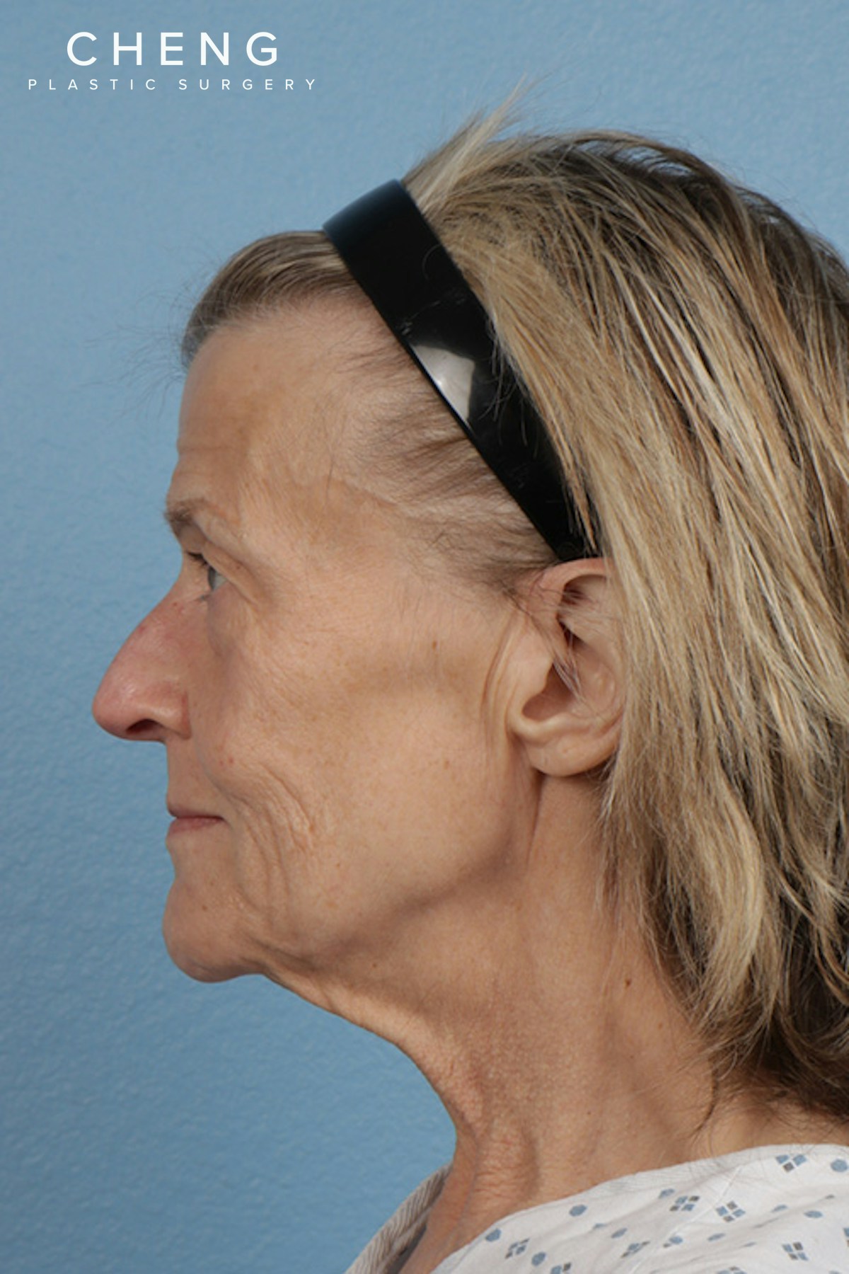 Hidden Patients Before & After Gallery - Patient 152793 - Image 9