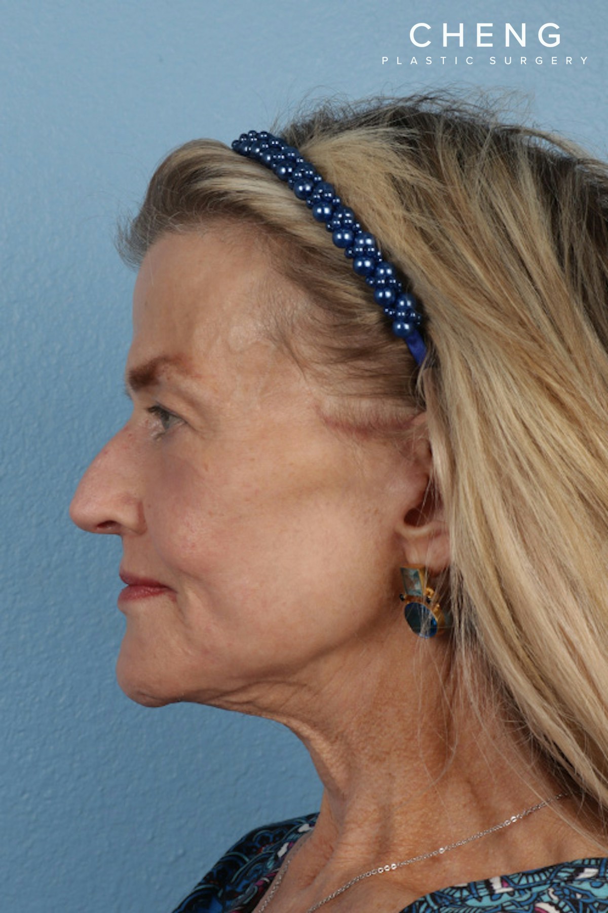 Hidden Patients Before & After Gallery - Patient 152793 - Image 10
