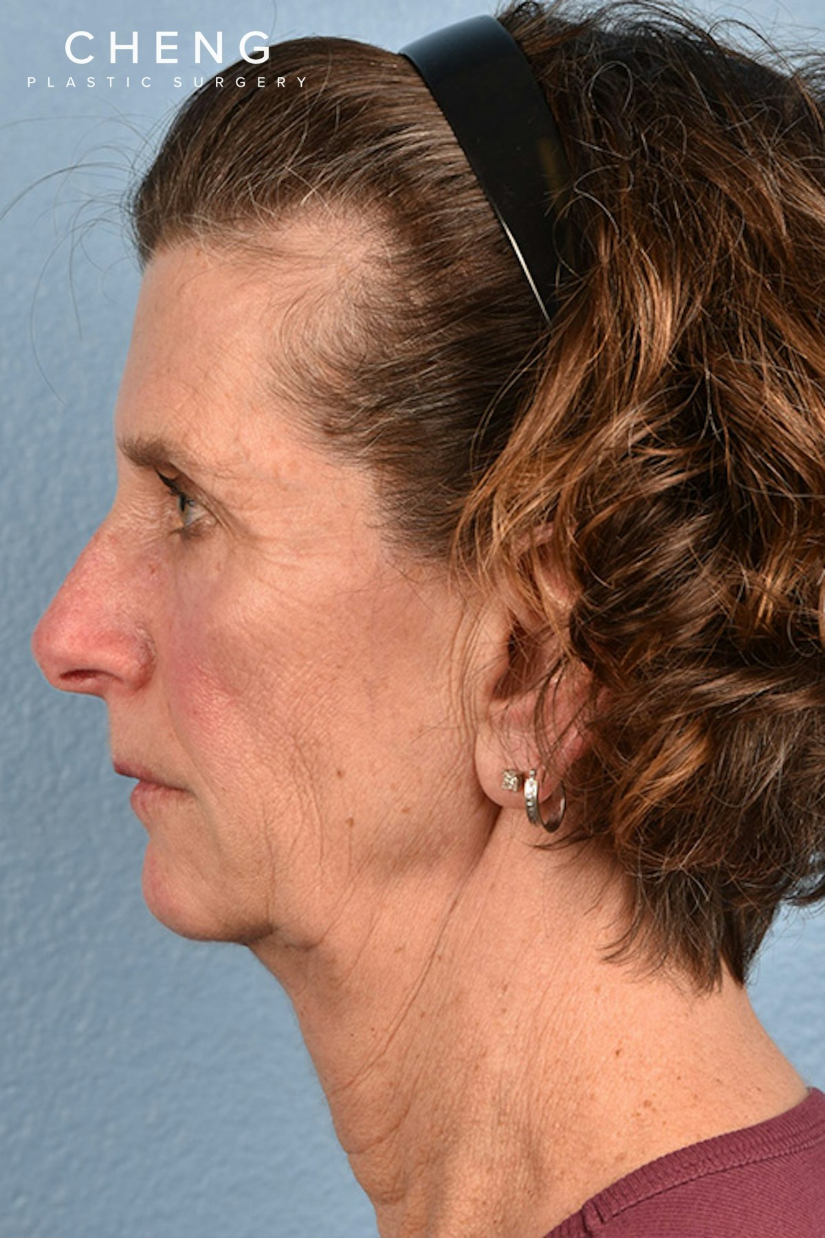 Hidden Patients Before & After Gallery - Patient 414780 - Image 1