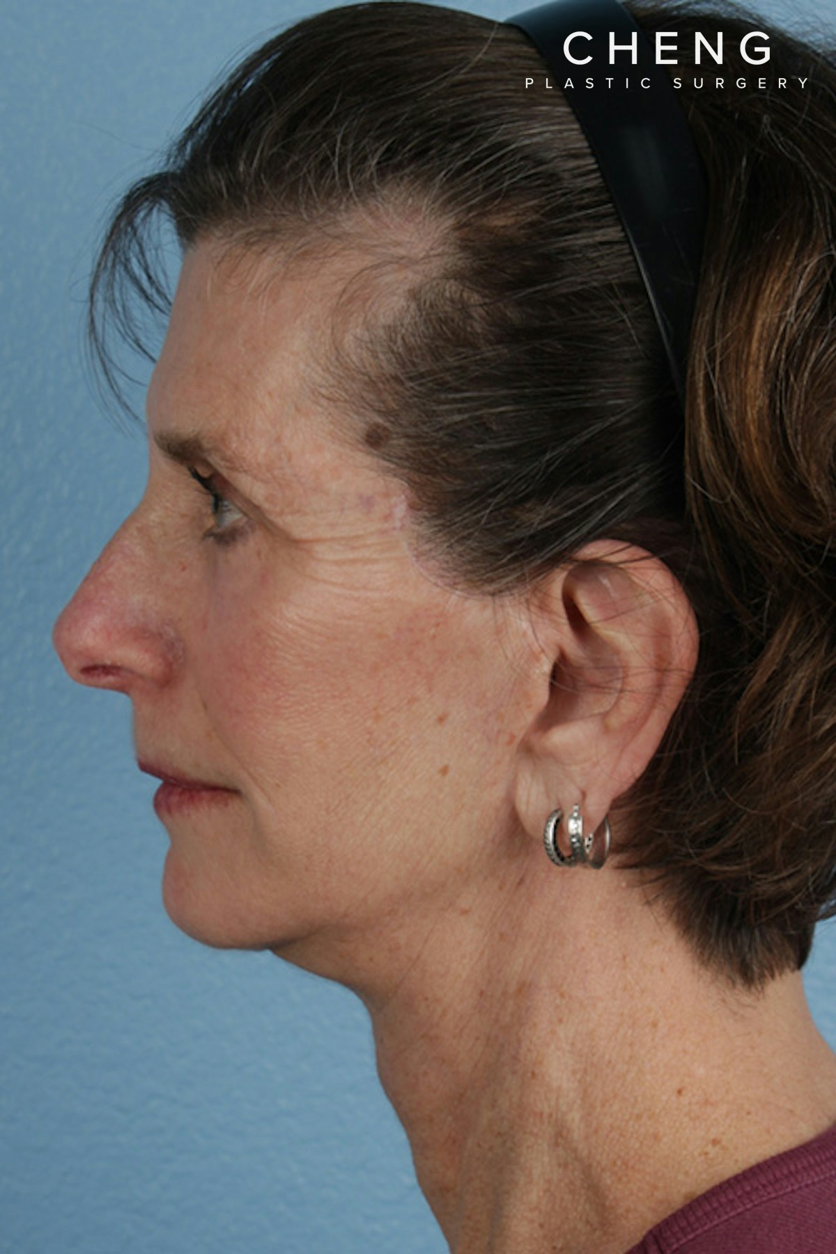 Hidden Patients Before & After Gallery - Patient 414780 - Image 2