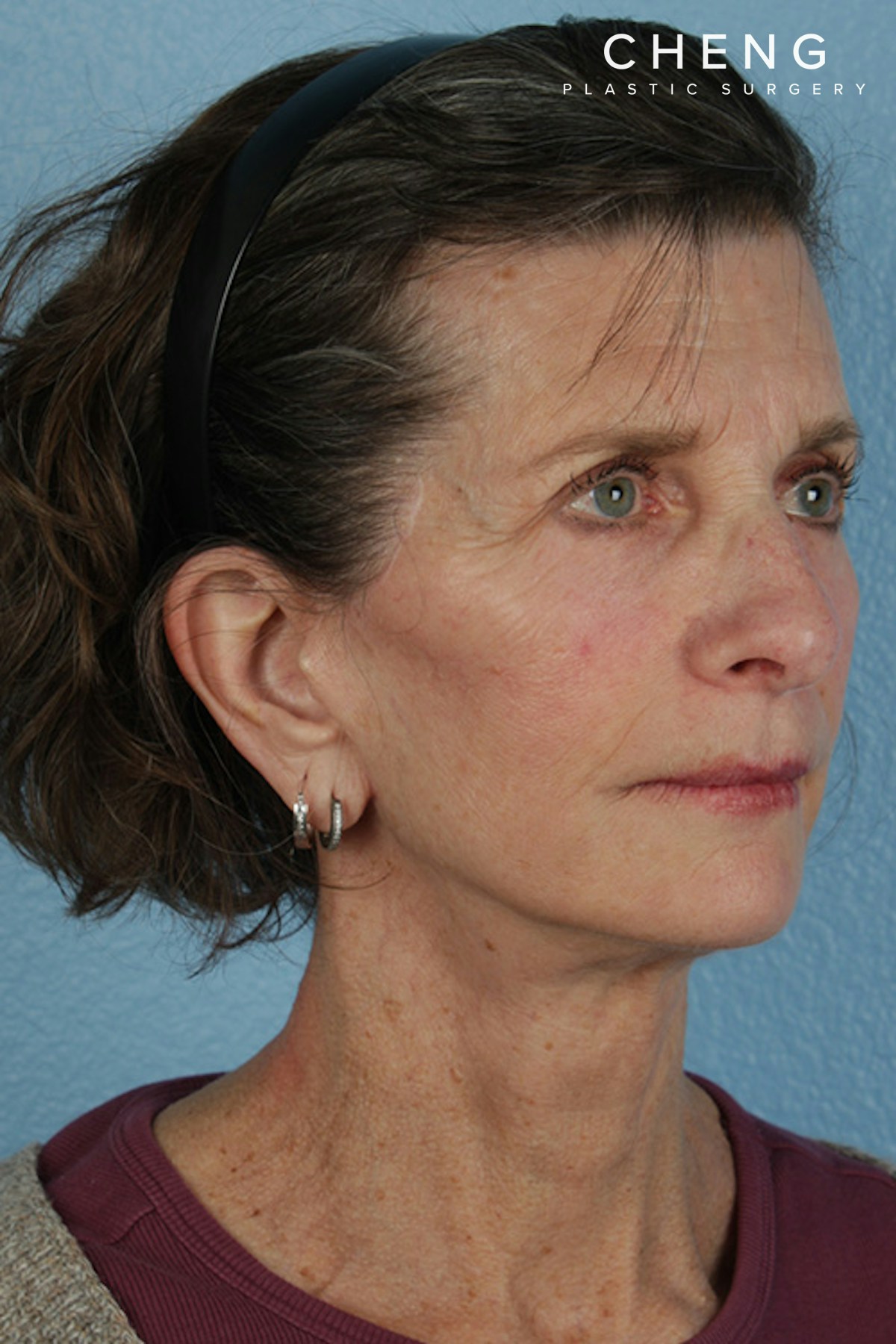 Hidden Patients Before & After Gallery - Patient 414780 - Image 4