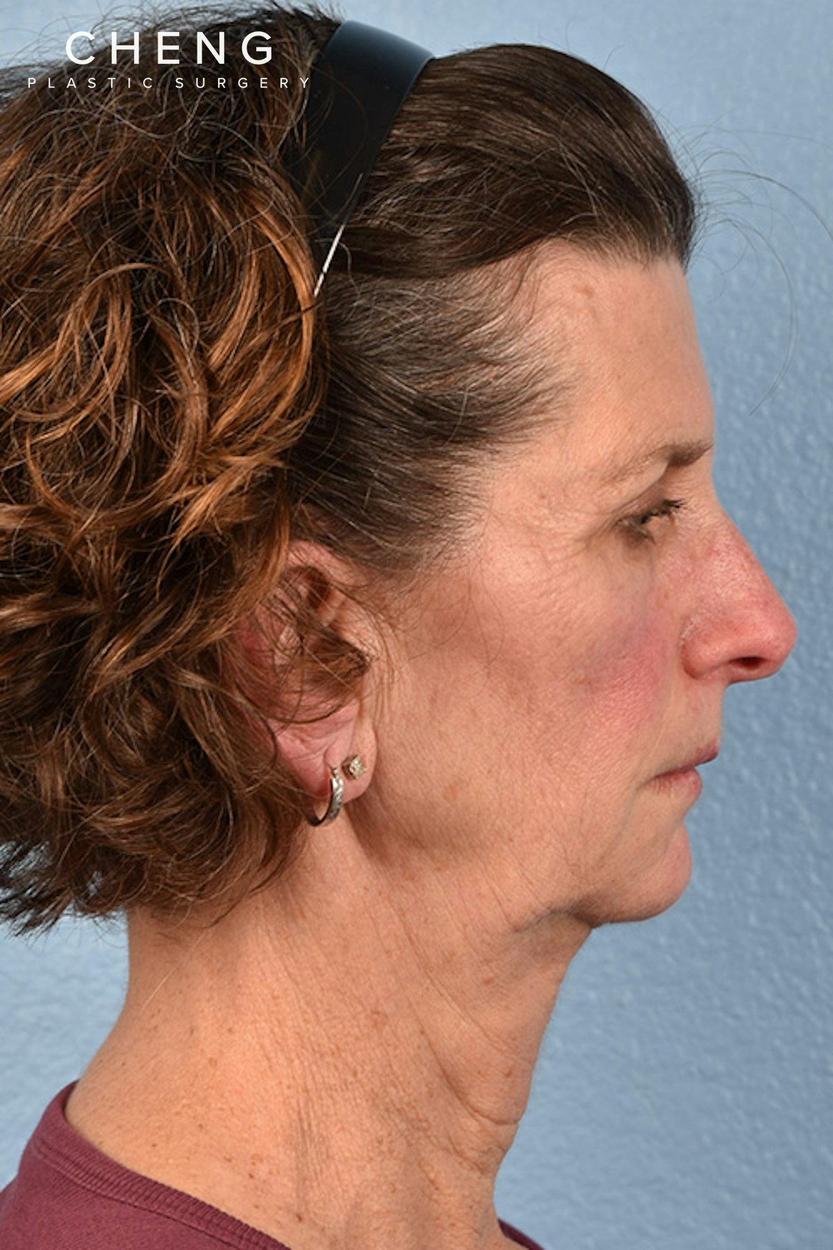 Hidden Patients Before & After Gallery - Patient 414780 - Image 5