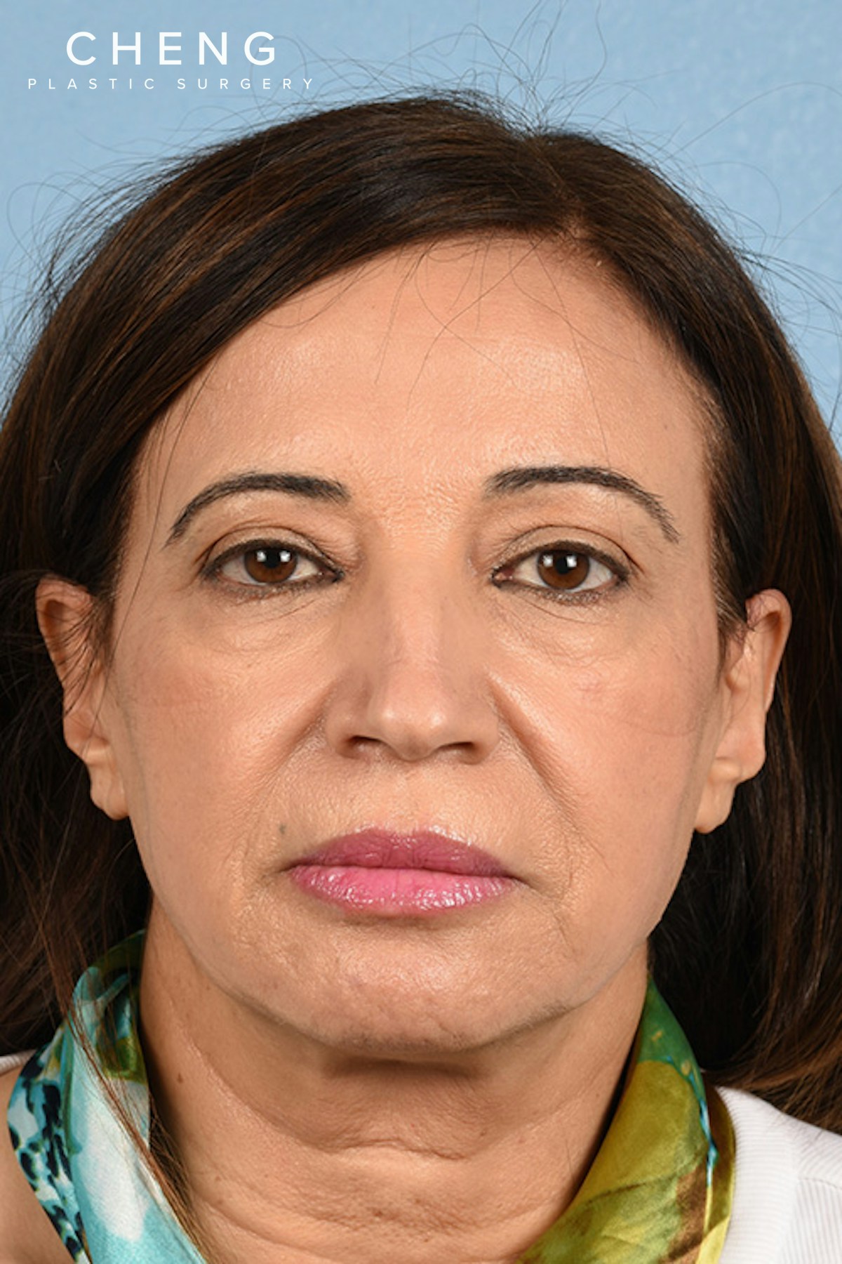 Hidden Patients Before & After Gallery - Patient 170701 - Image 1