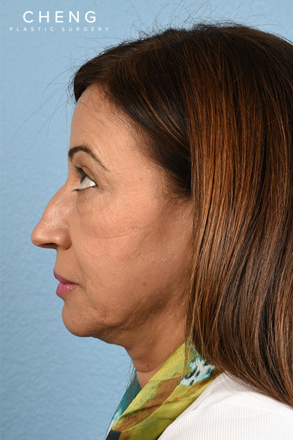 Hidden Patients Before & After Gallery - Patient 170701 - Image 3