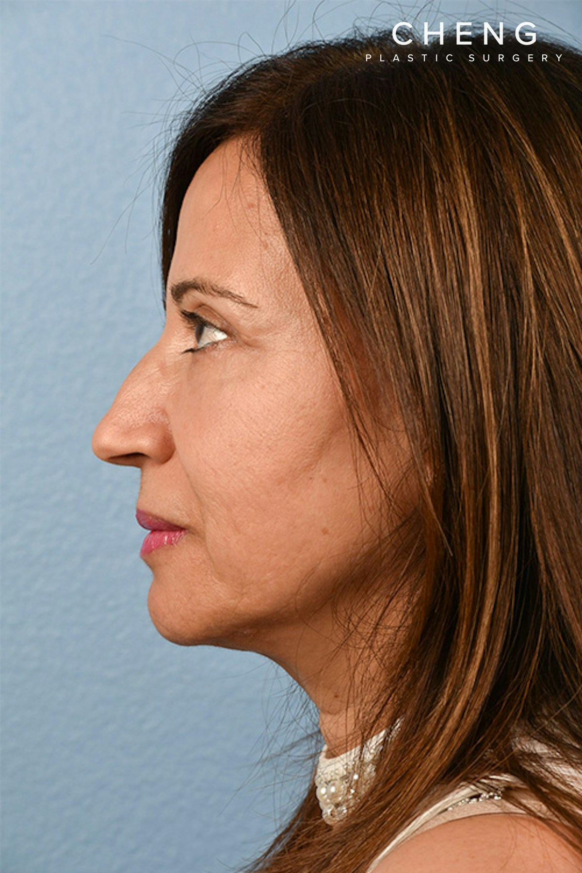 Hidden Patients Before & After Gallery - Patient 170701 - Image 4