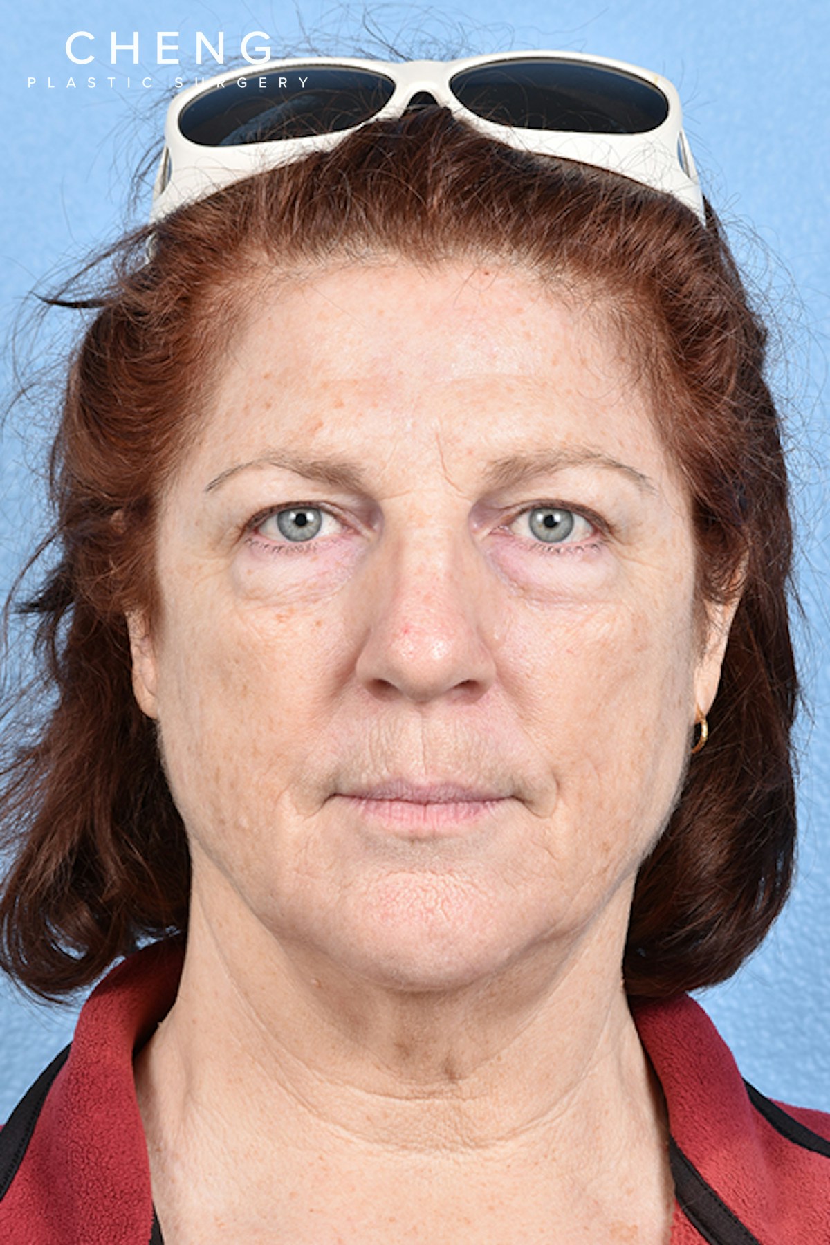 Hidden Patients Before & After Gallery - Patient 100587 - Image 1