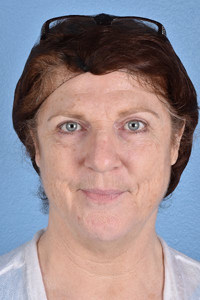 Hidden Patients Before & After Gallery - Patient 100587 - Image 2