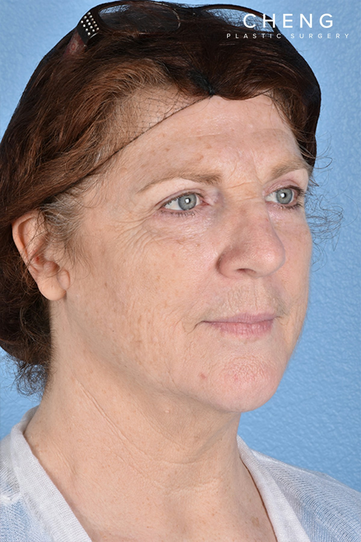 Hidden Patients Before & After Gallery - Patient 100587 - Image 4