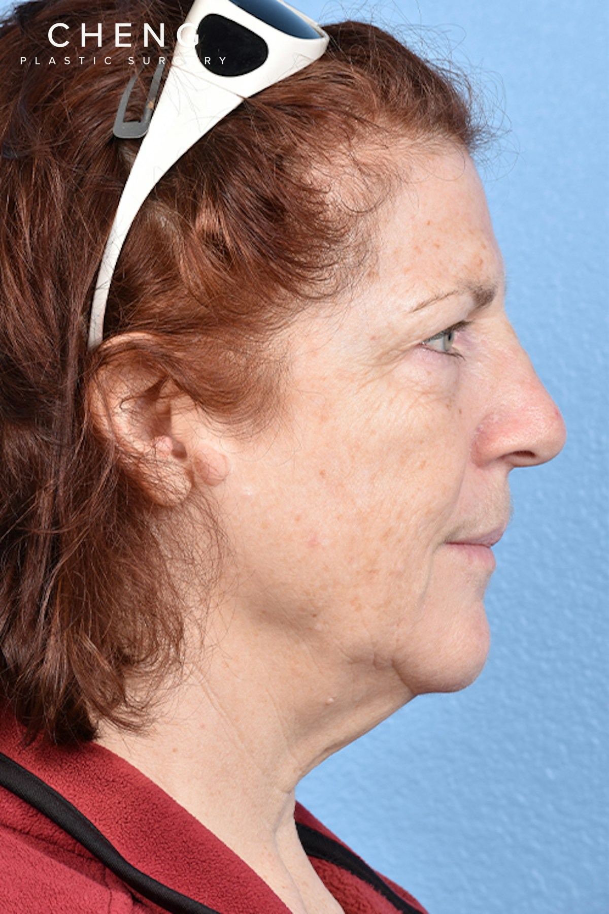 Hidden Patients Before & After Gallery - Patient 100587 - Image 5