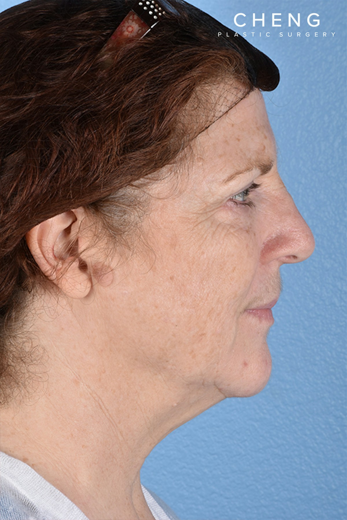 Hidden Patients Before & After Gallery - Patient 100587 - Image 6