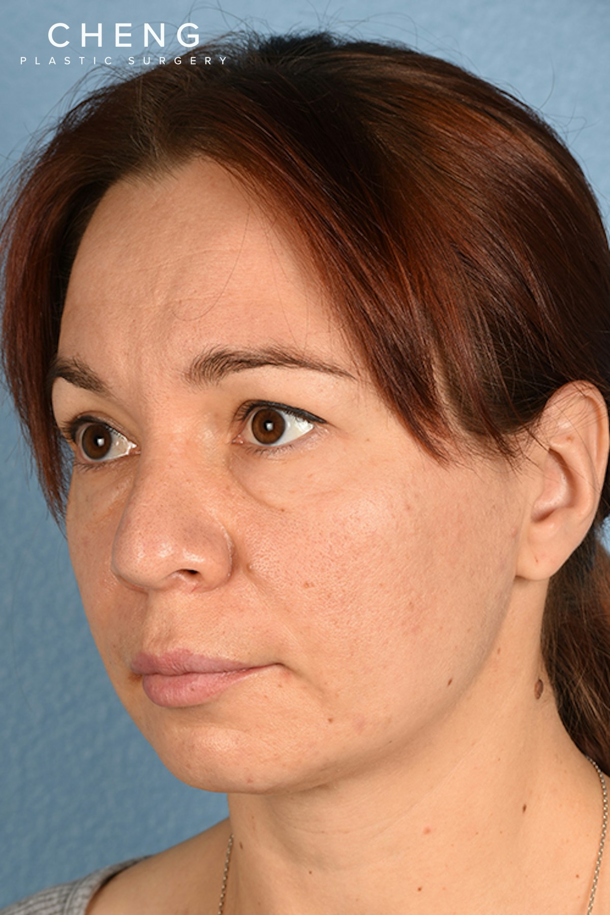 Hidden Patients Before & After Gallery - Patient 363424 - Image 3