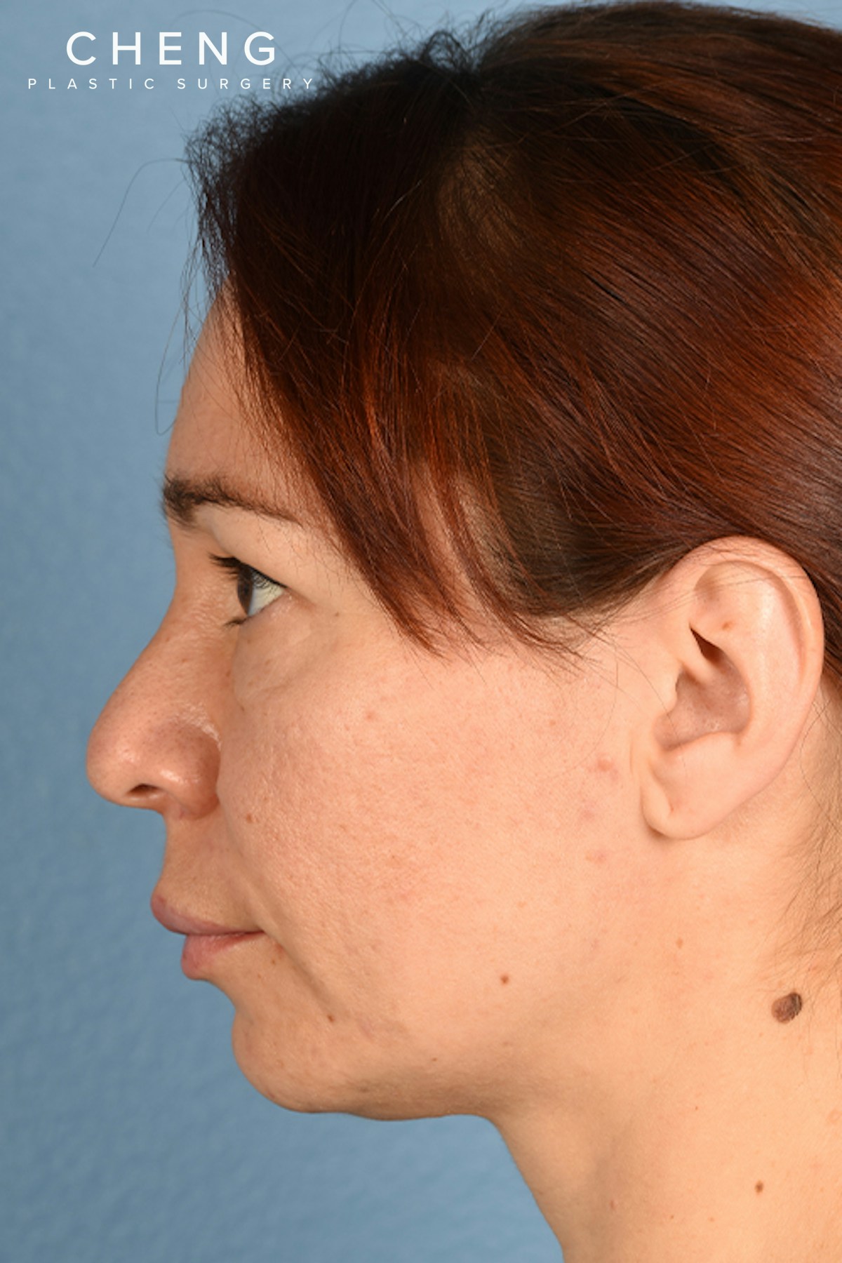 Hidden Patients Before & After Gallery - Patient 363424 - Image 5