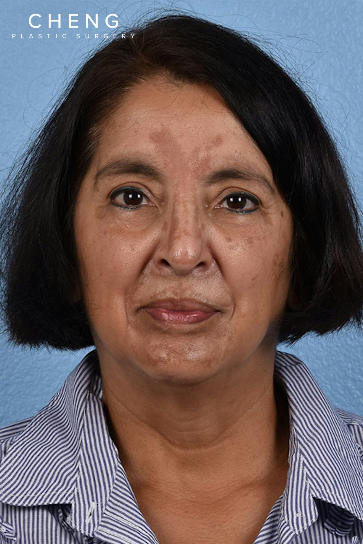 Hidden Patients Before & After Gallery - Patient 231097 - Image 1