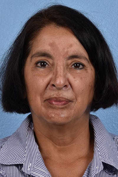 Hidden Patients Before & After Gallery - Patient 231097 - Image 1