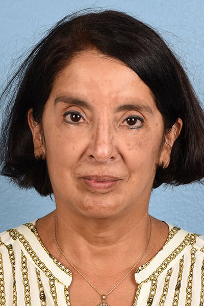 Hidden Patients Before & After Gallery - Patient 231097 - Image 2