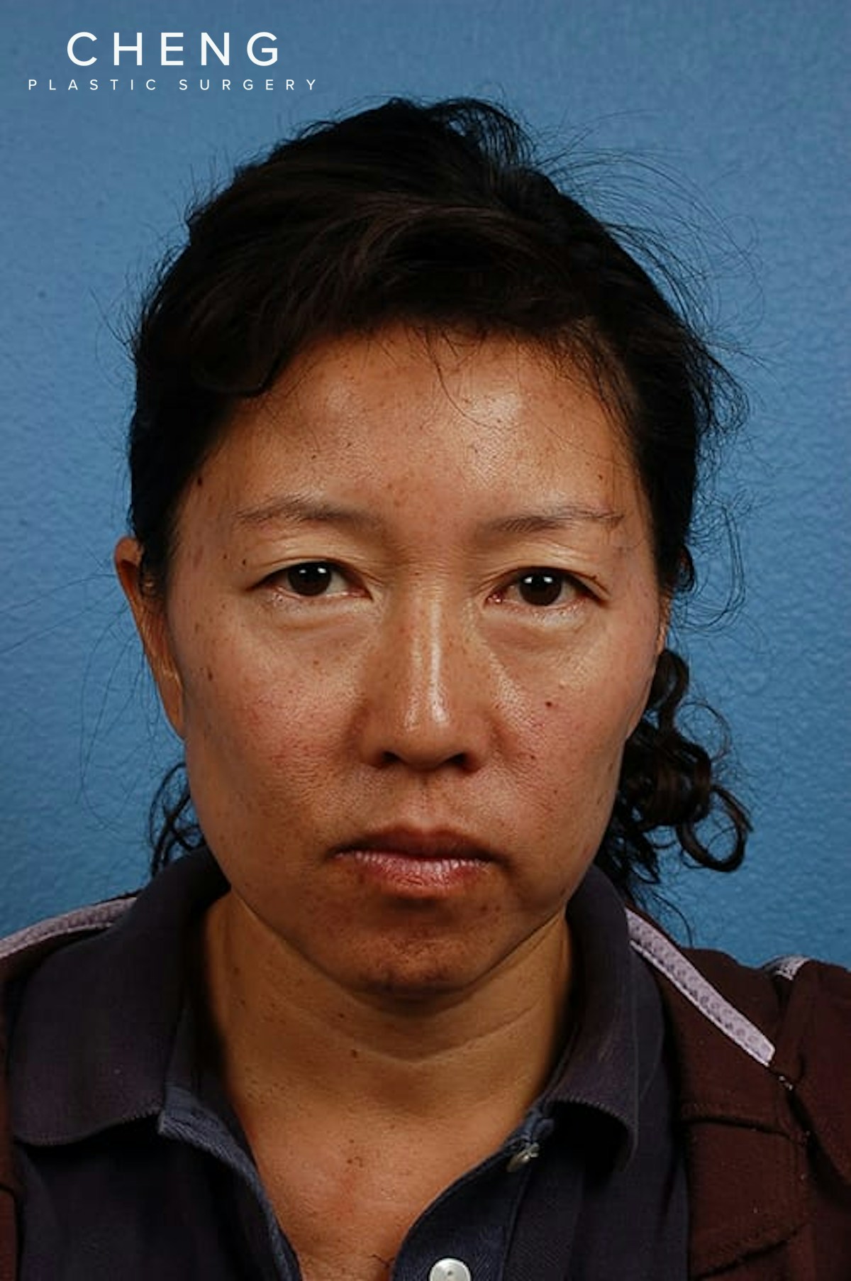 Hidden Patients Before & After Gallery - Patient 767922 - Image 1