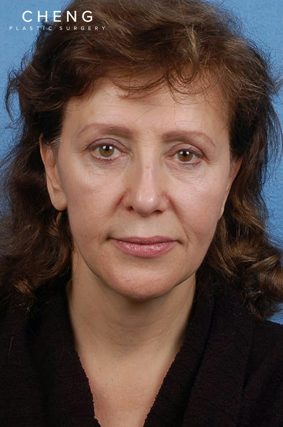Hidden Patients Before & After Gallery - Patient 418015 - Image 1