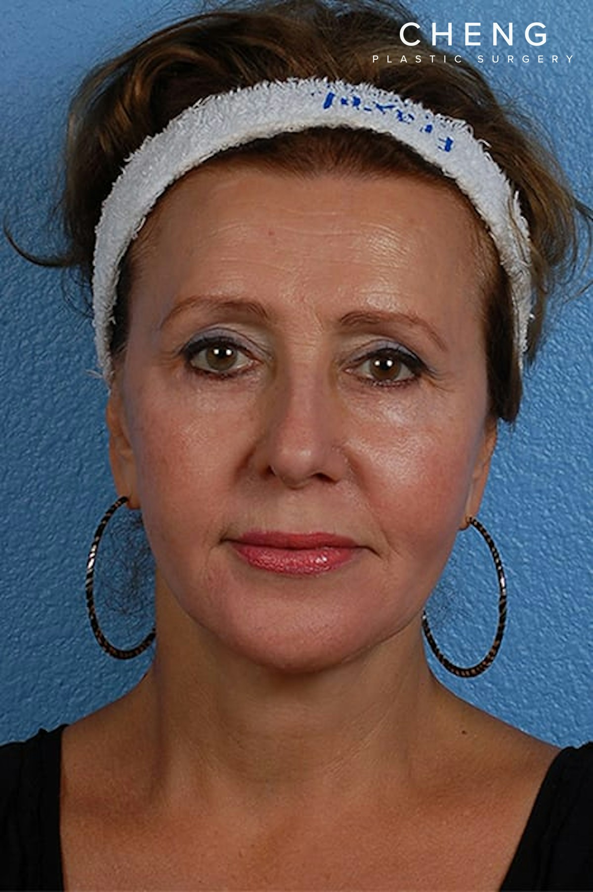 Hidden Patients Before & After Gallery - Patient 133964 - Image 2
