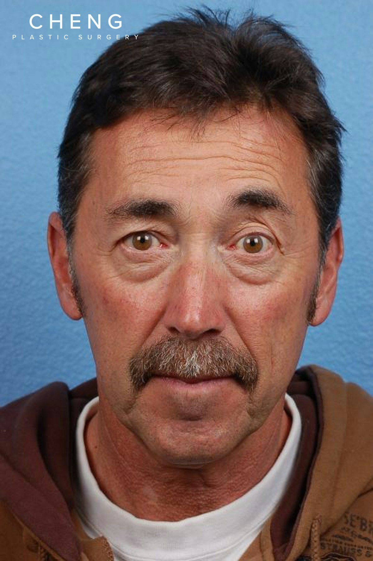 Hidden Patients Before & After Gallery - Patient 357550 - Image 1