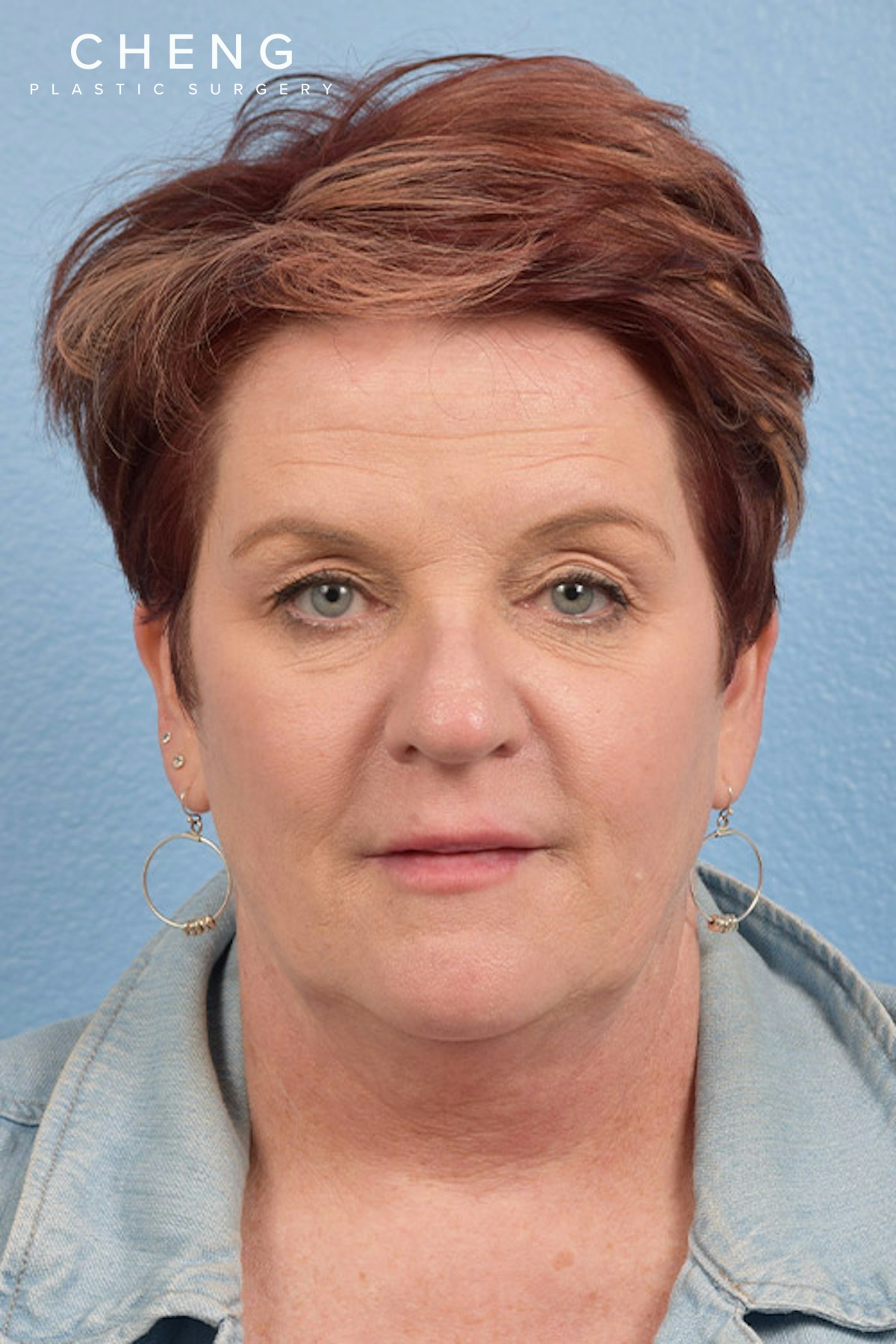 Hidden Patients Before & After Gallery - Patient 167428 - Image 1