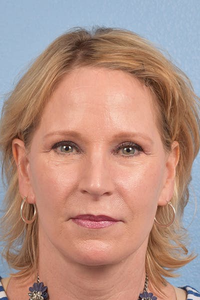 Hidden Patients Before & After Gallery - Patient 530071 - Image 2