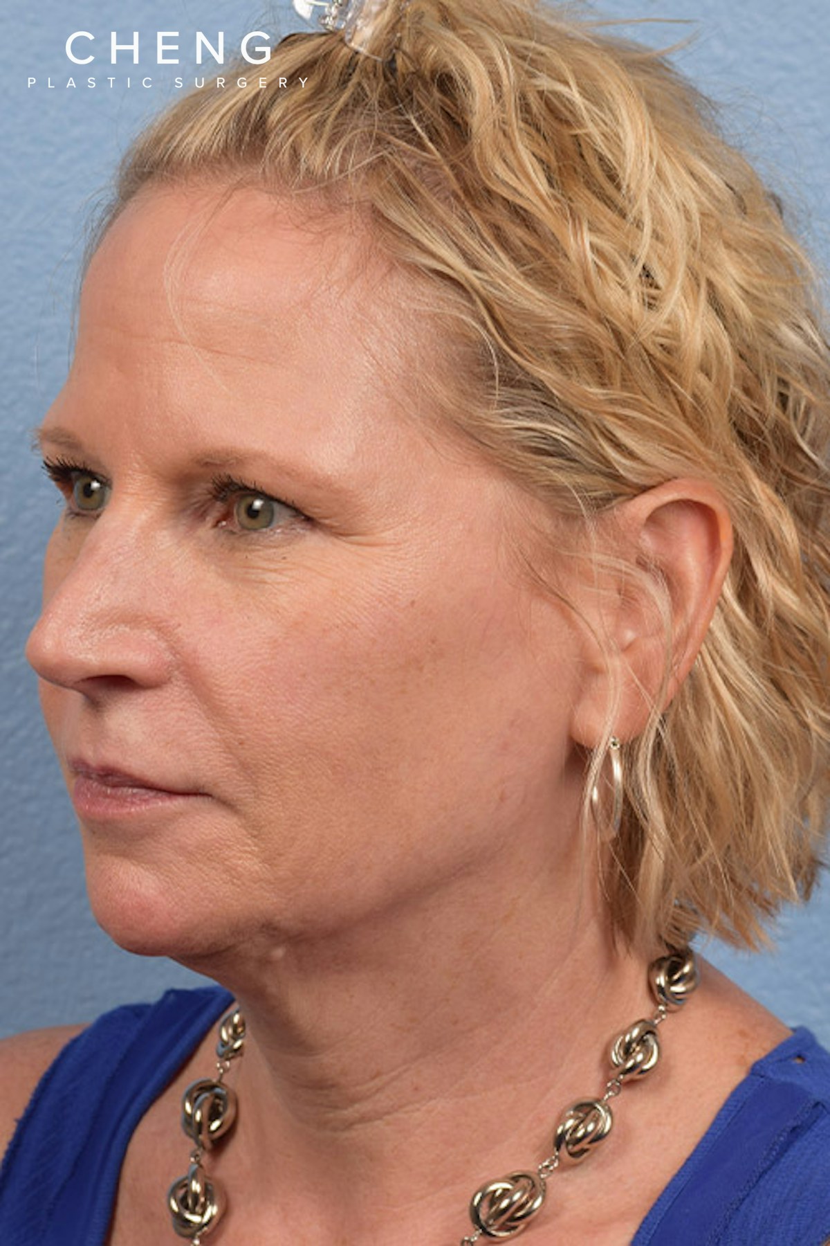Hidden Patients Before & After Gallery - Patient 530071 - Image 3