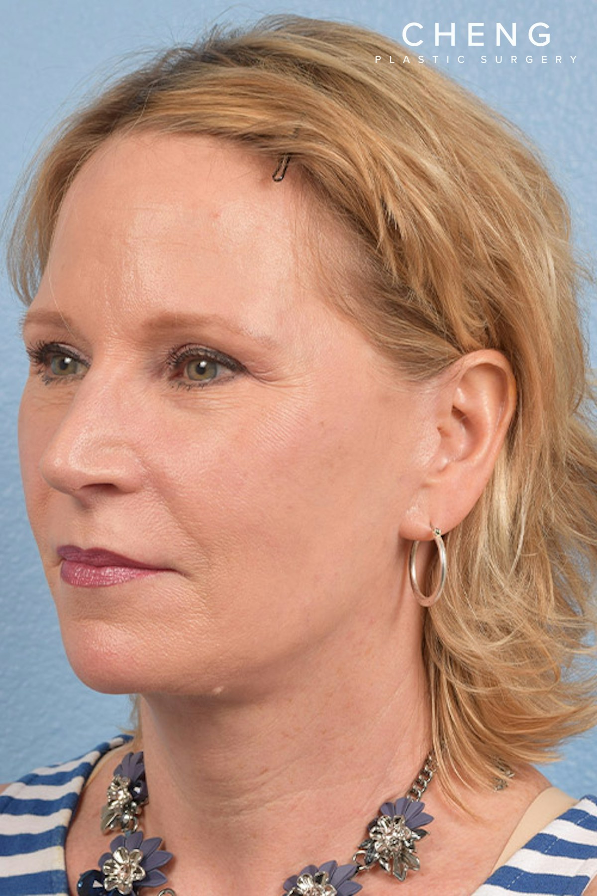 Hidden Patients Before & After Gallery - Patient 530071 - Image 4