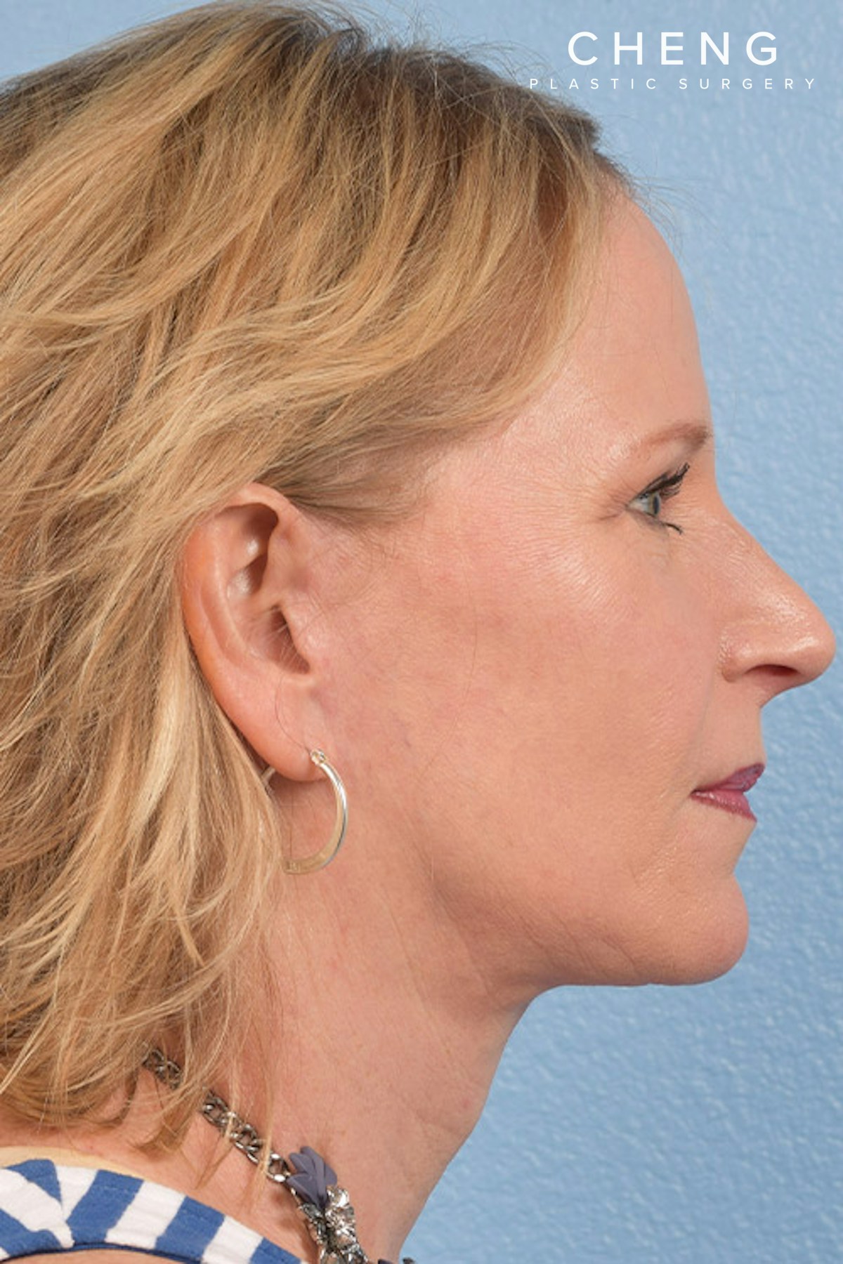 Hidden Patients Before & After Gallery - Patient 530071 - Image 10