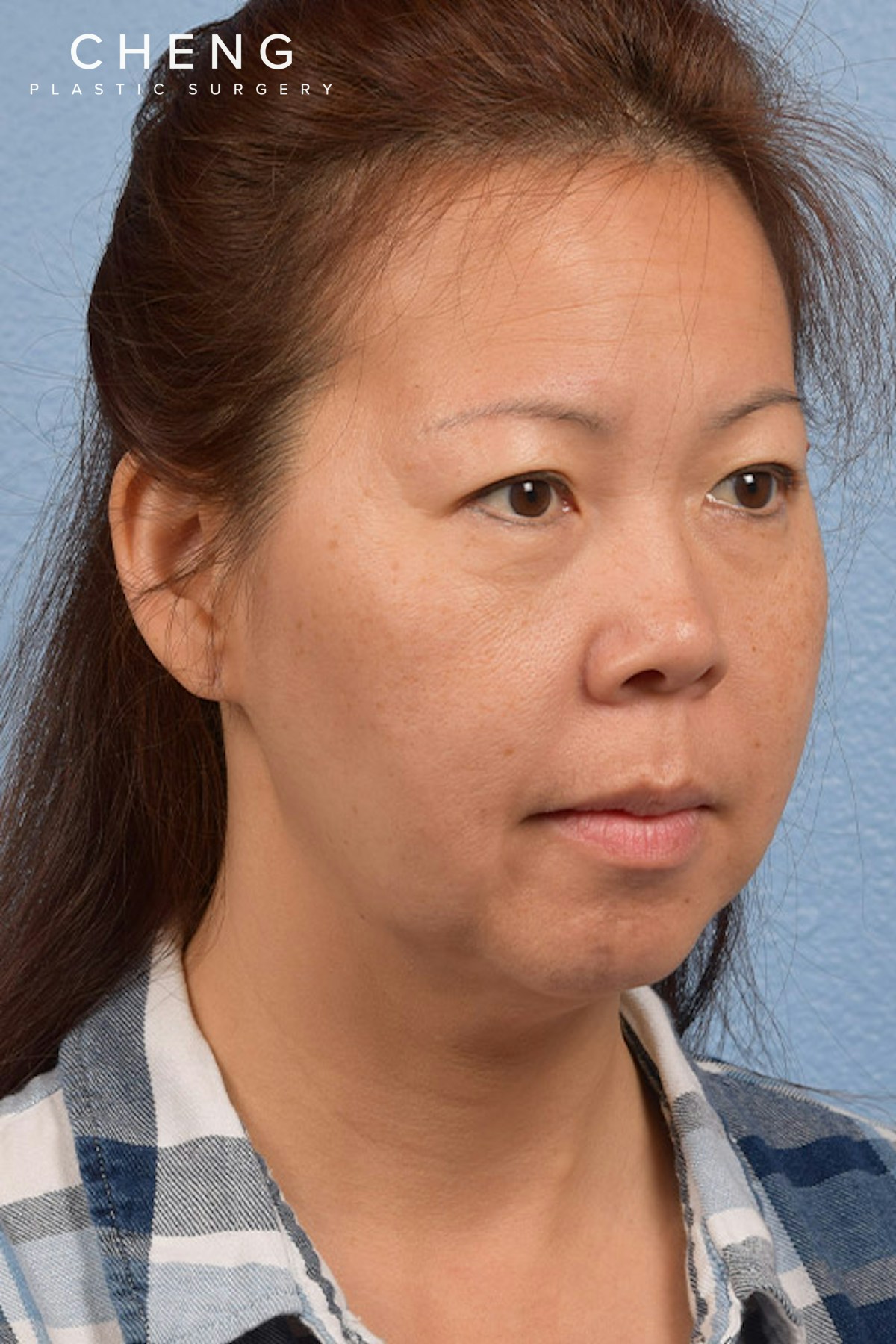 Hidden Patients Before & After Gallery - Patient 272098 - Image 7