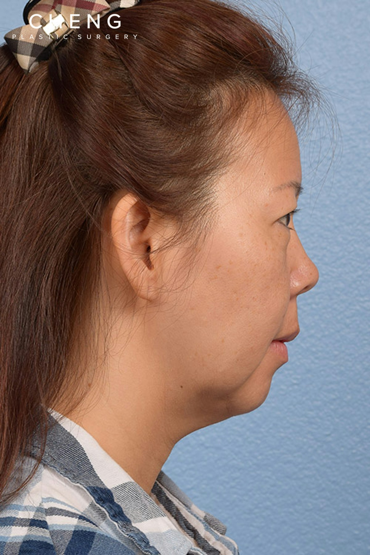Hidden Patients Before & After Gallery - Patient 272098 - Image 9