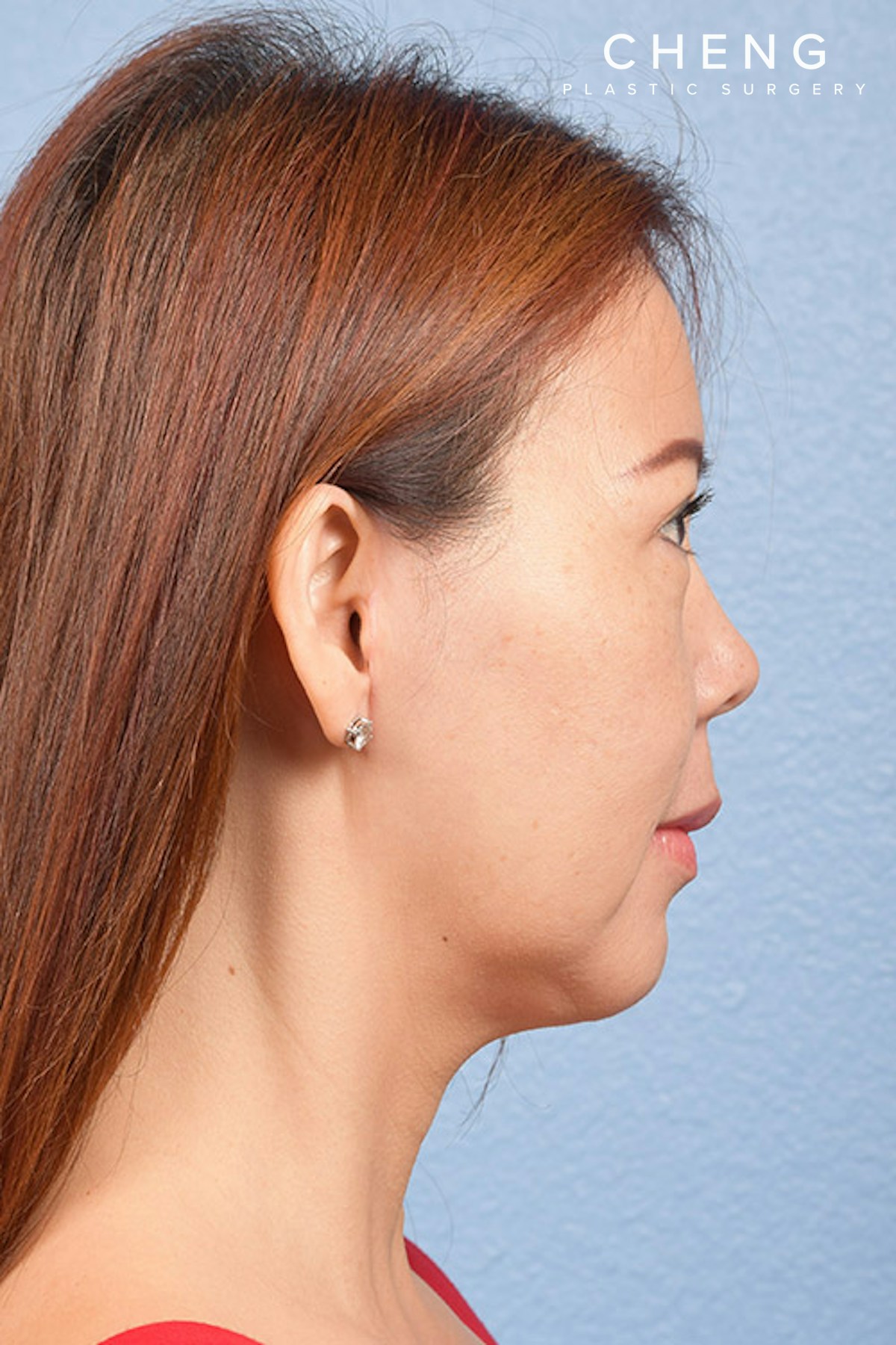 Hidden Patients Before & After Gallery - Patient 272098 - Image 10
