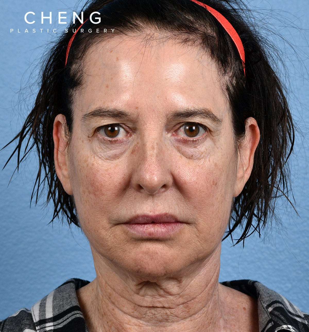 Hidden Patients Before & After Gallery - Patient 345137 - Image 1